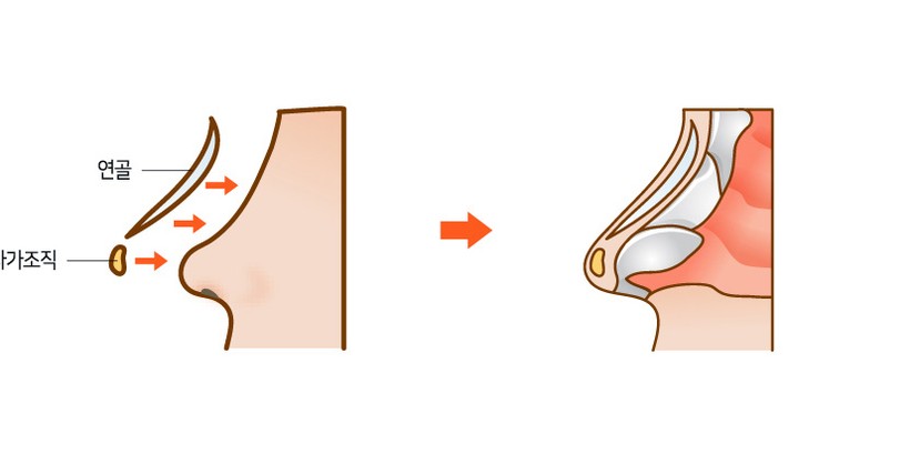 짧은코성형 수술 단면 일러스트