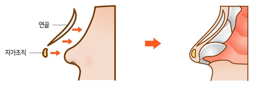 자가조직코성형 수술방법 수술 일러스트