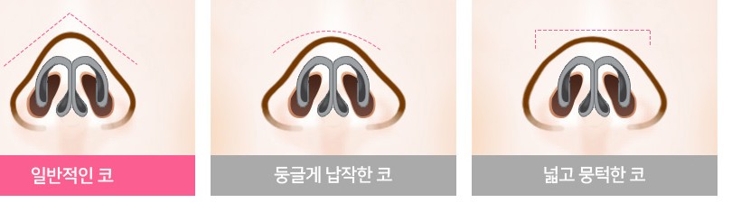 복코 3가지 유형 단면 비교 일러스트