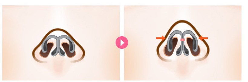 CASE 01. 날개연골이 크거나 벌어진 경우 수술 일러스트