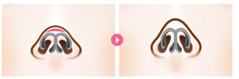 CASE 02. 피하지방이 많고 피부조직이 두꺼운 경우 수술 일러스트