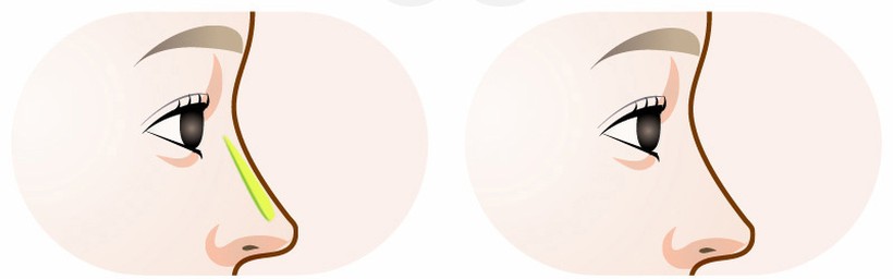 피부가 얇아 보형물이 비쳐 보이는 경우 수술 일러스트