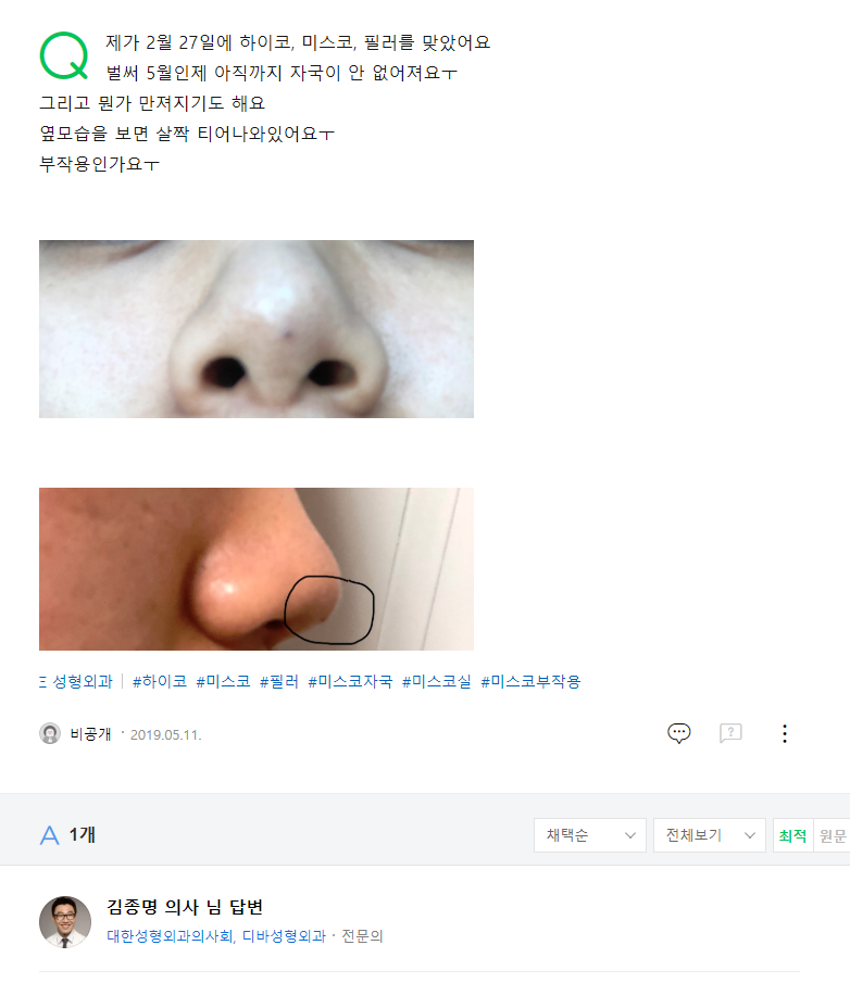 제가 2월 27일에 하이코, 미스코, 필러를 맞았어요 네이버 지식인 상담 원문