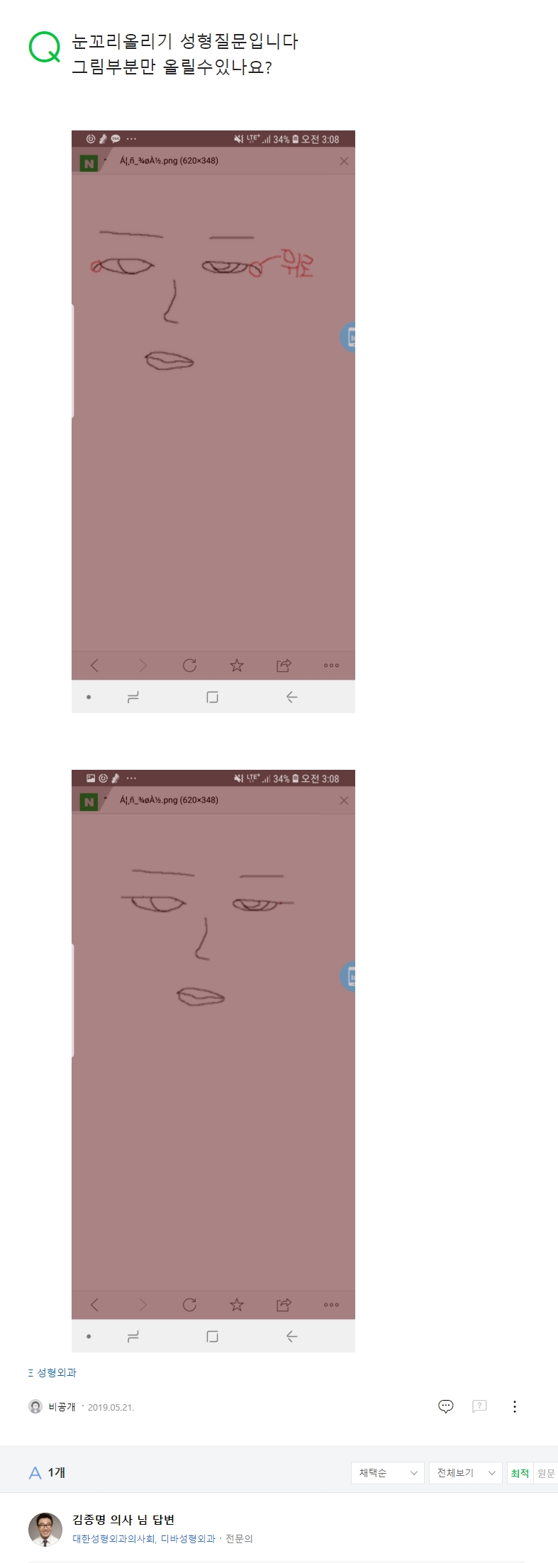 눈꼬리올리기 성형질문입니다 그림부분만 올릴수있나요? 네이버 지식인 상담 원문