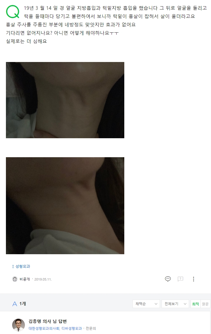 19년 3 월 14 일 경 얼굴 지방흡입과 턱밑지방 흡입을 했습니다 네이버 지식인 상담 원문