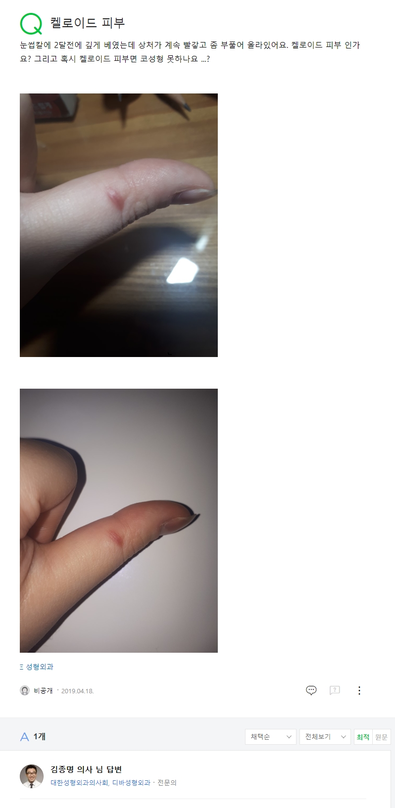 켈로이드 피부 네이버 지식인 상담 원문